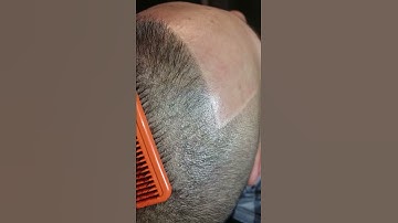 Scalp Micropigmentation (Density)