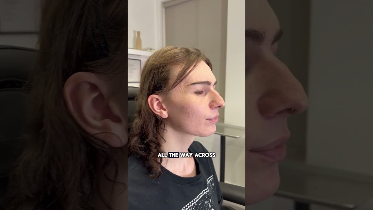 The most requested facial change in FFS 👀 