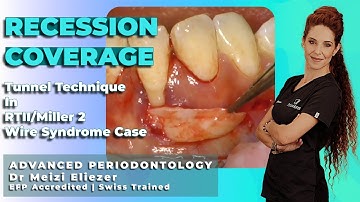 Tunnel Technique Recession Coverage (SCTG + Emdogain®) in RT2/Miller III Wire Syndrome Case