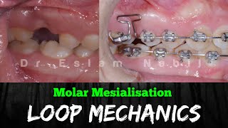 Orthodontic Trick - Loop Mechanics - Mesialisation - Space Closure غلق المسافات - تقويم الأسنان