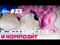 Ниндзя доступ и композит  | Дентал Кейсы от BG #23