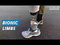 Bionics are the future of prosthetics