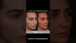 Before and after rhinoplasty - Dr Guncel Ozturk #beforeandafter #rhinoplastyturkey #drgo