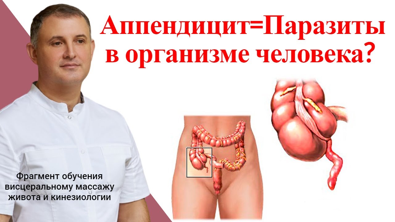 Аппендицит=Паразиты в организме человека? Лечение и профилактика - YouTube