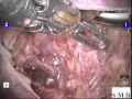 Robotic d&#39;Hoore anterior rectopexy for rectal prolapse