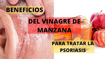 ¿Es bueno beber vinagre para la psoriasis?