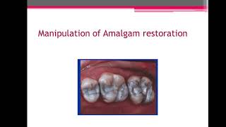 manipulation of amalgam restoration