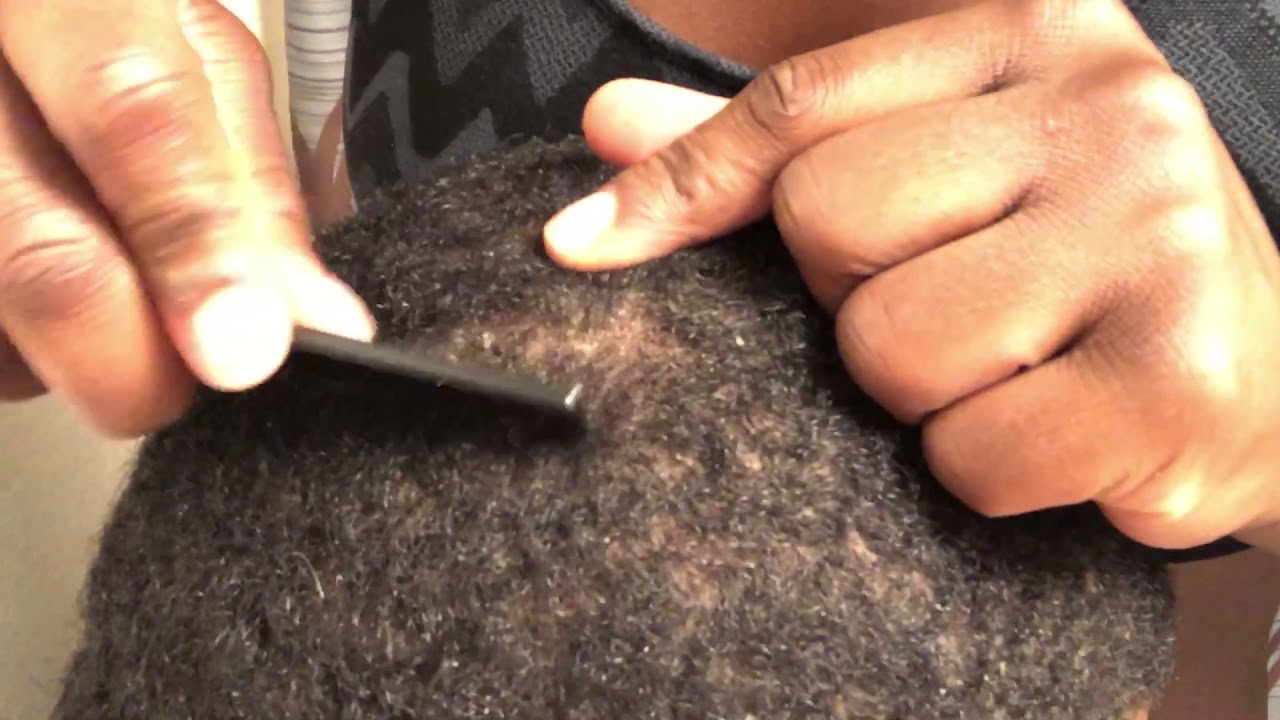 OMG So Much Dandruff YouTube
