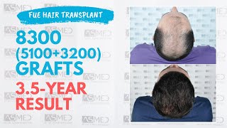 Manual FUE Hair Transplant 8300 (5100 3200) Grafts 3,5-Year Result - ASMED - Dr. Koray Erdogan