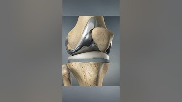 Total knee replacement (3D Animation)