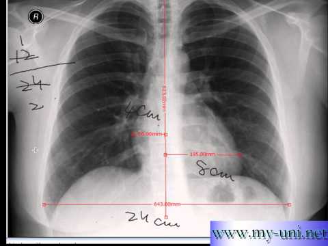 Chest x-ray -Cardiothoracic Ratio -CARDIAC SIZE - Cardiomegaly