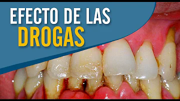 ¿Qué droga te vuelve los dientes grises?