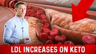 Cardiologist dr Nadir Ali Explains Ldl Bad Cholesterol Spike With Keto  Drberg