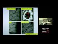 Balloon Pulmonary Angioplasty for CTEPH - Dr David Boshell