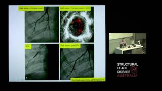 Balloon Pulmonary Angioplasty for CTEPH - Dr David Boshell