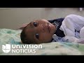 Zika in Brazil: The daily struggle of a mother and her baby with microcephaly