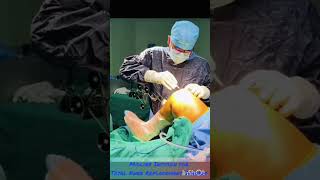 Midline Incision ##kneereplacement #kneepain #orthopedicsurgeon #surgery #doctor #hospital #viral
