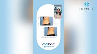 Cooltone Before & After Photos Does Cooltone Work? Element Body Lab Dallas, Tx