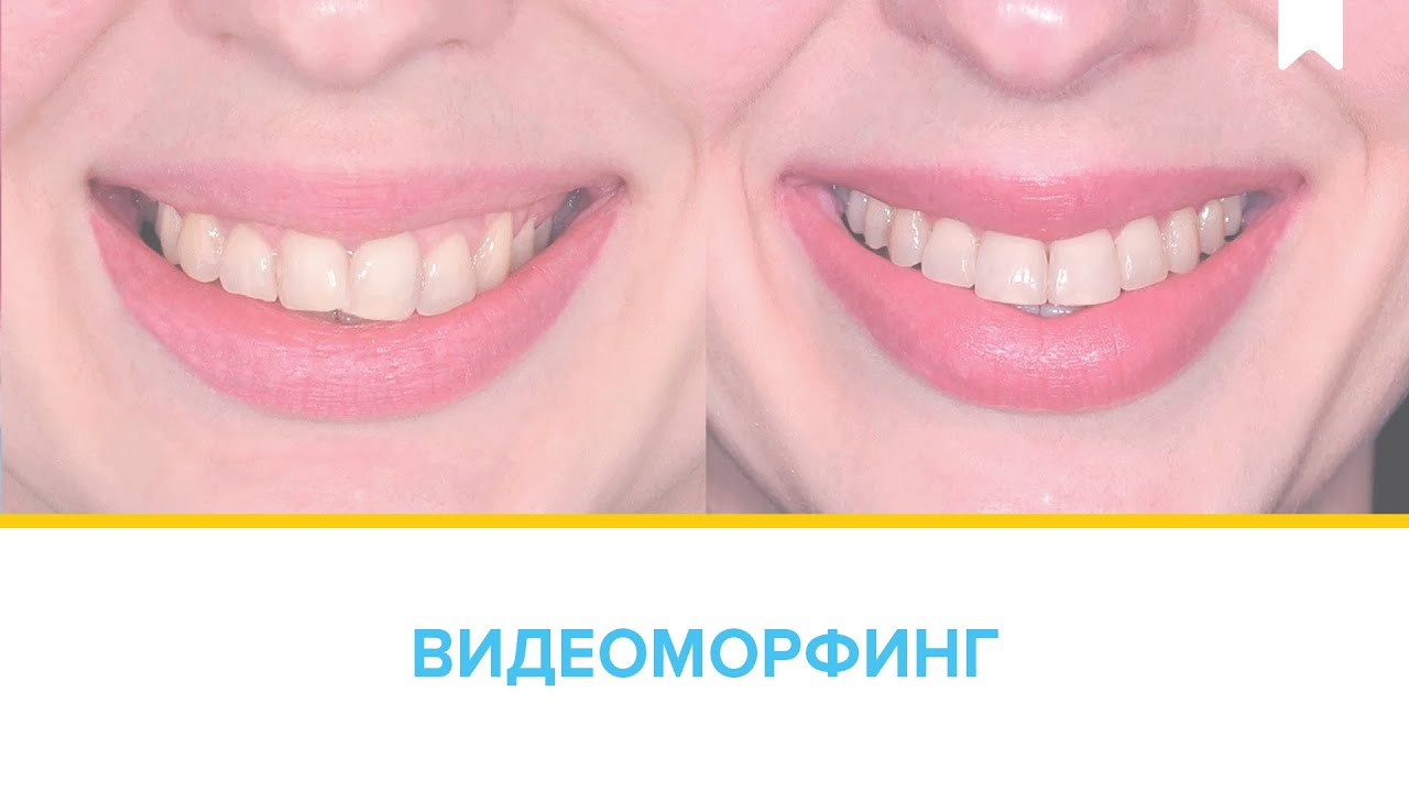 Результаты лечения дистального прикуса путем дистализации к минивинтам без удаления.