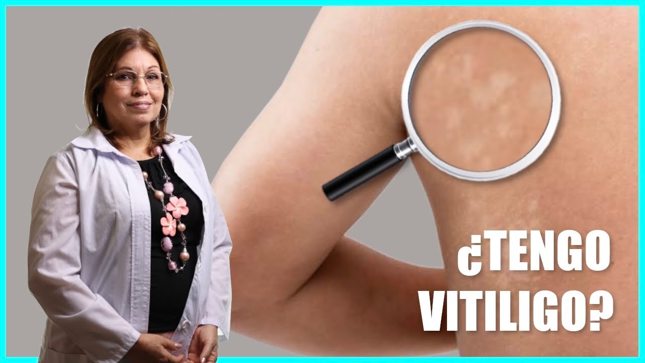 🔸Manchas BLANCAS en la piel ¿Cómo diferenciarlas? 🤔 *Vitiligo o PSORIASIS*