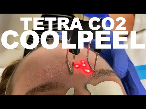 Dot Laser Therapy Youtube