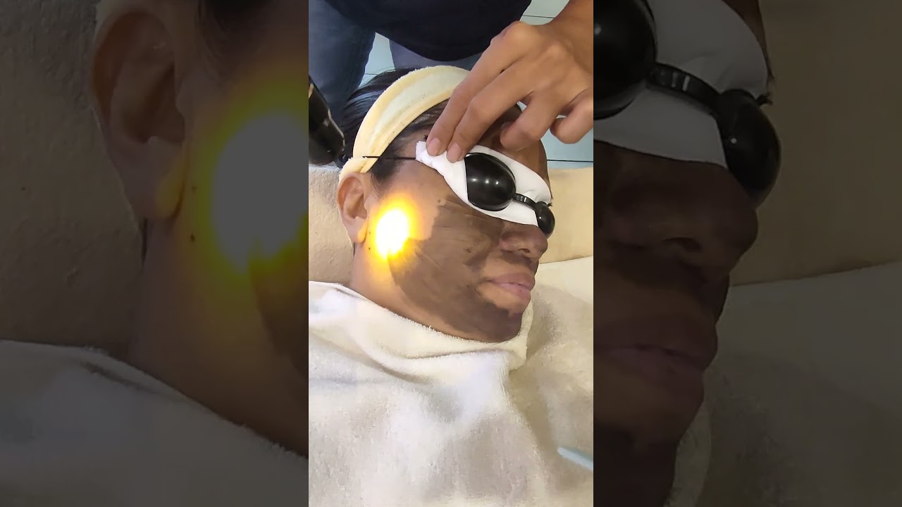 Black Doll Carbon Laser Treatment