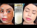 4 Step Challenge -  Remove DARK SPOTS &amp; PIGMENTATION