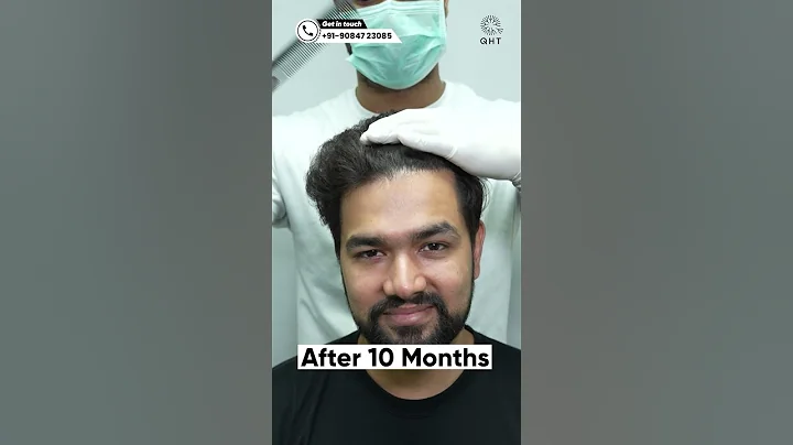 Ten Months Hair Transplant Result | Latest Fue Technique #shorts #viral #hair transplant