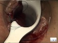 Longo procedure for haemorroidal prolapse