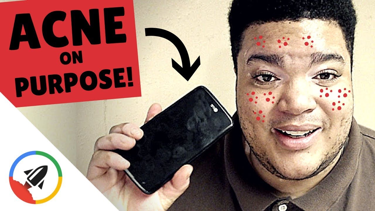 How To Get ACNE 9 Avoidable Ways YouTube