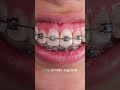 Pasos para reparar un diente fracturado