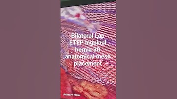 Laparoscopic Inguinal Hernia Repair with 3D Mesh