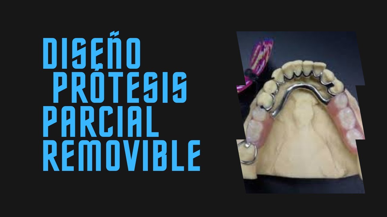 DISEÑO [Prótesis Parcial Removible] - YouTube