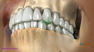 Canine Guidance   Normal Occlusion