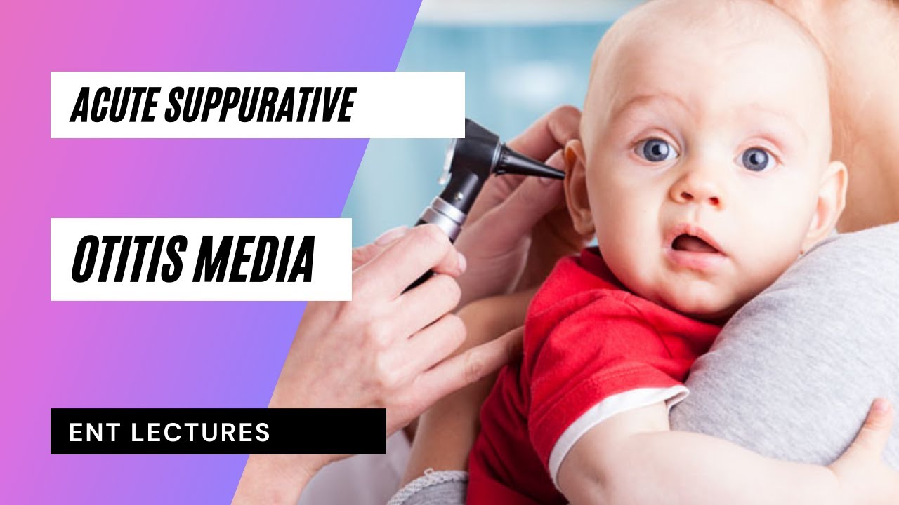 Acute Suppurative Otitis Media Ent Lectures Youtube