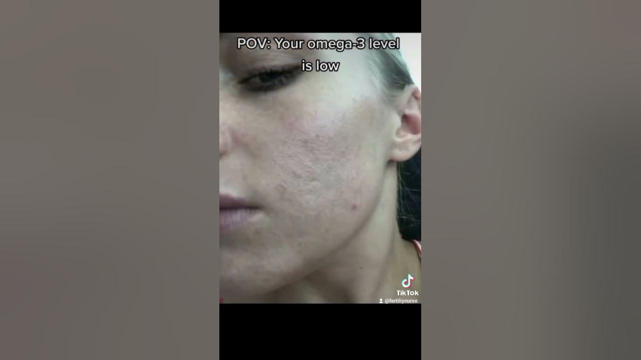 signs of Low Omega 3 level nursmuna fertilitynurse skincare skin