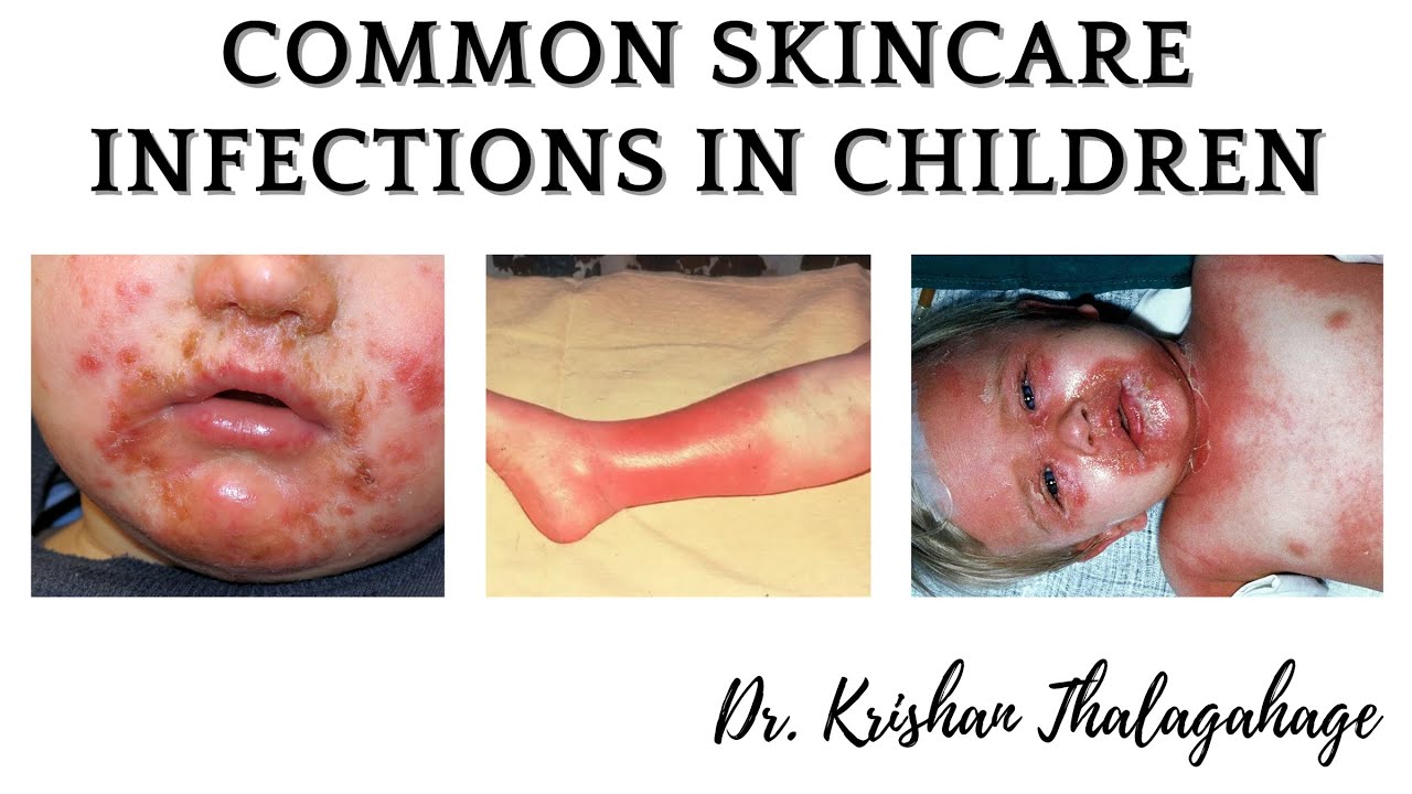 Common Skin Infections In Children | Dr. Krishan Thalagahage - YouTube