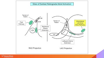 Complex Cases Simplified:  AVNRT Part II with Warren "Sonny" Jackman, MD