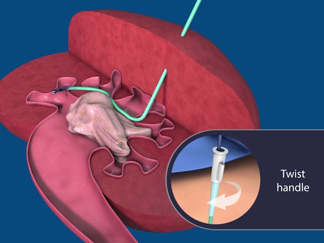 PCNL Simplified Animation