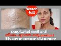 Acne Prone: A Product my skin hates!My updated skincare Malayalam Beauty Blogger/Vlogger