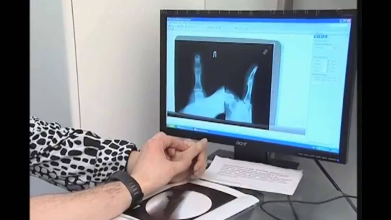 Мельников В.С. - Опухоль кисти - Медмолл - YouTube