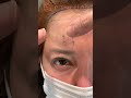 額の緩みからくる目周りのお悩みは前額リフトで解決👀 #前額リフト #フェイスリフト #美容