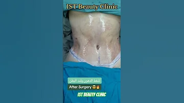 Before And After Lipo360 And Tummytuck Surgery قبل وبعد عملية شفط الدهون وشد البطن 
