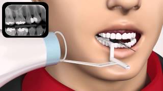 dental digital sensor holders (Densmart CO., Taiwan)
