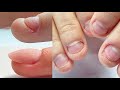 Cómo dejar de morderse las uñas? Manicura - de uñas mordidas a uñas hermosas