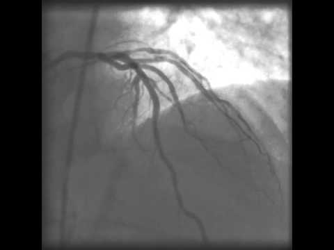 Коронарные артерии сердца пмжв. Стентирование пмжв. Стентирование пмжв. Стентирование пмжв. Стентирование пмжв.