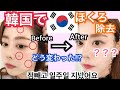 韓国美容！大きかったホクロのその後は..?１週間で消えるの⁇