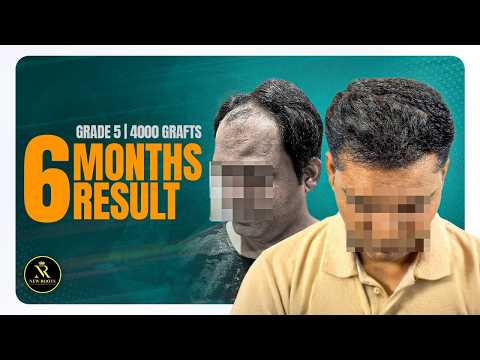High Density Hair Transplant in Vashi 😮 | Best Hair Transformation | Navi Mumbai
