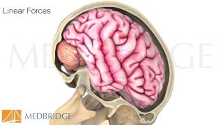 Concussion- Assessment, Screening, & Risk Factors Video: Anne Mucha & Susan Whitney | MedBridge