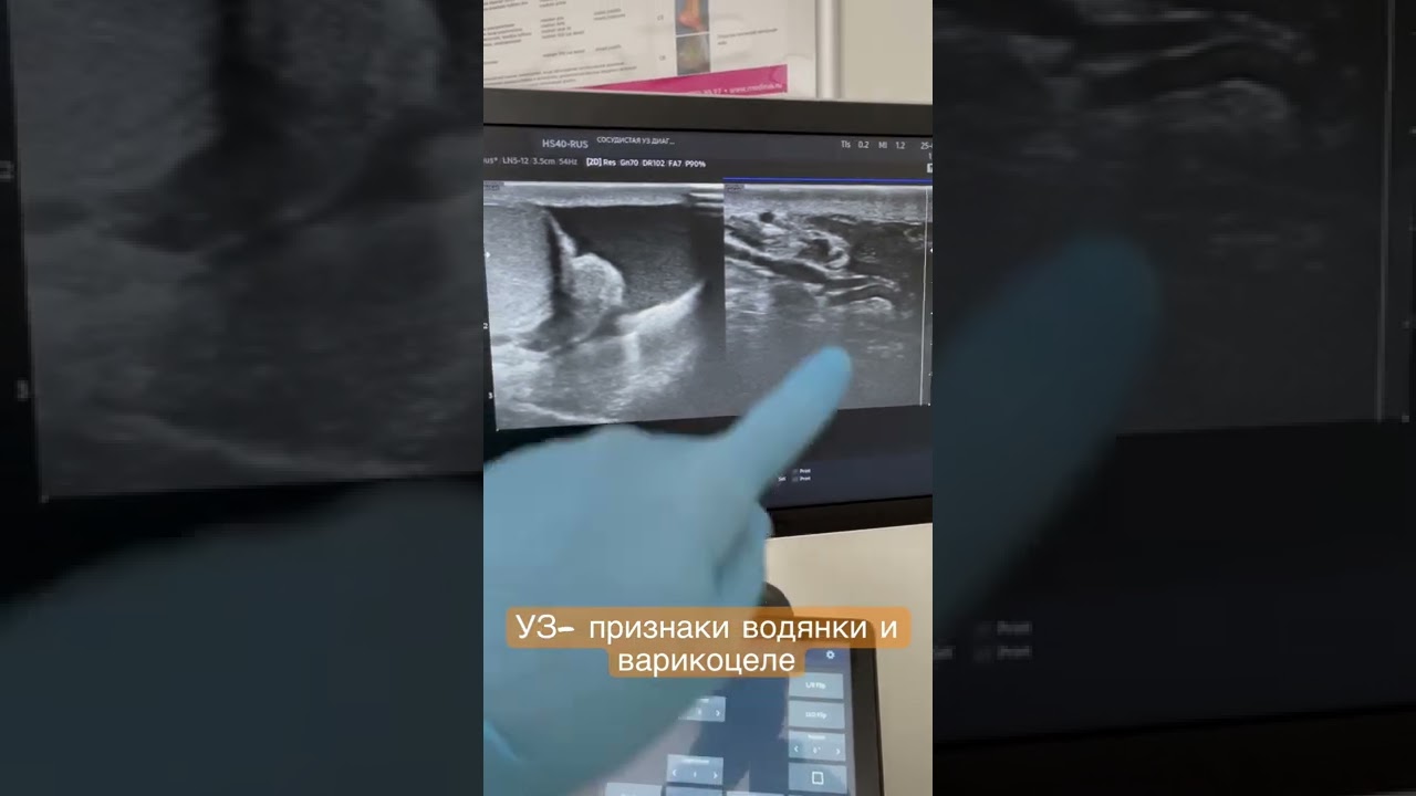 УЗ-признаки водянки и варикоцеле. Урология. ФлебологМосква - YouTube